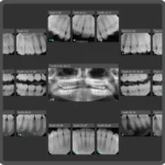 X Ray Teeth images
