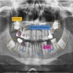 X Ray analized with AI