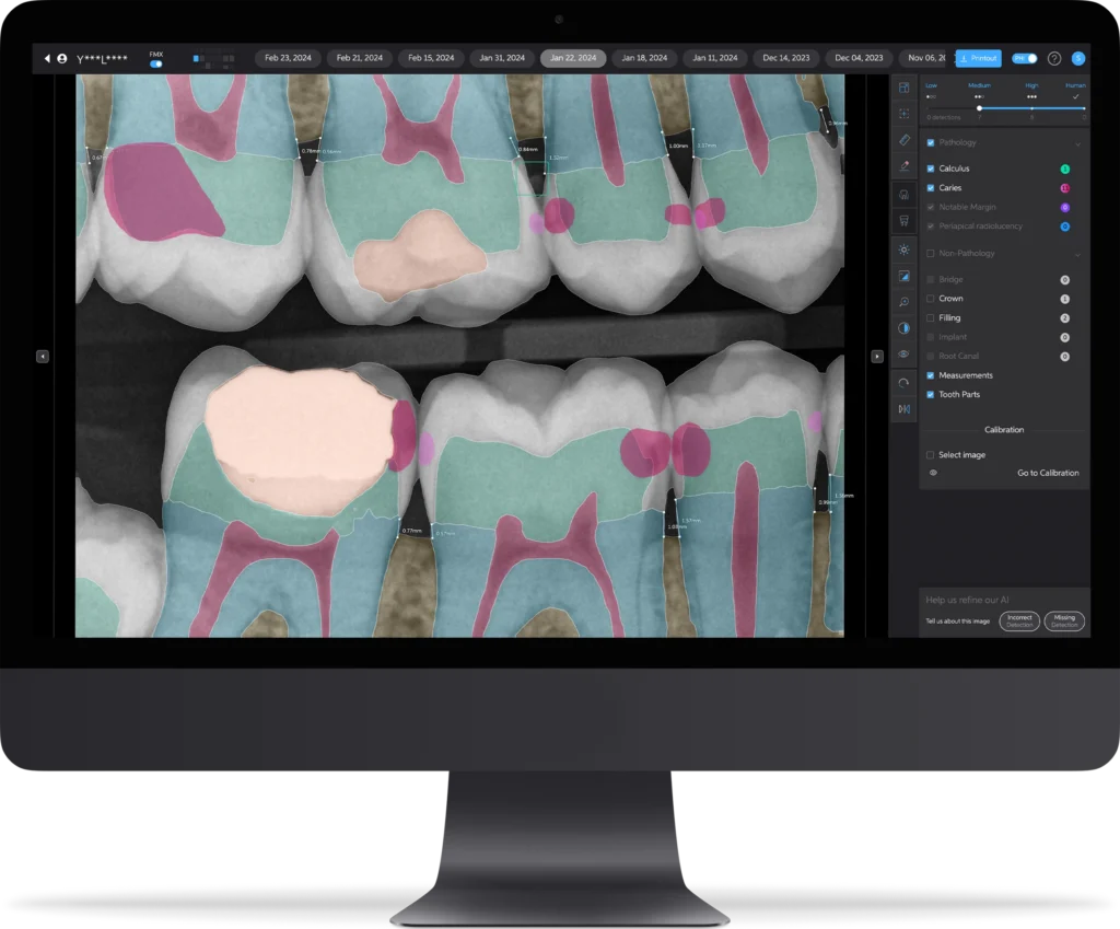 Pearl AI Tooth part front