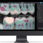 Pearl AI Tooth part front